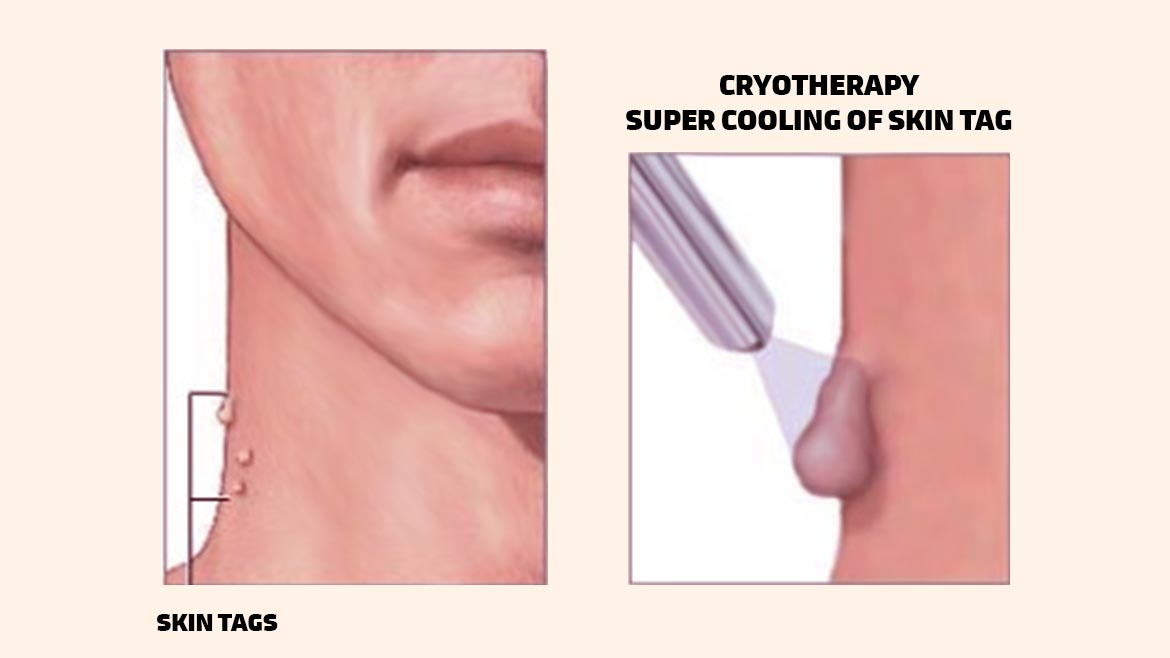 http://drritulaiker.in/wp-content/uploads/2022/07/cryosurgery-1.jpg