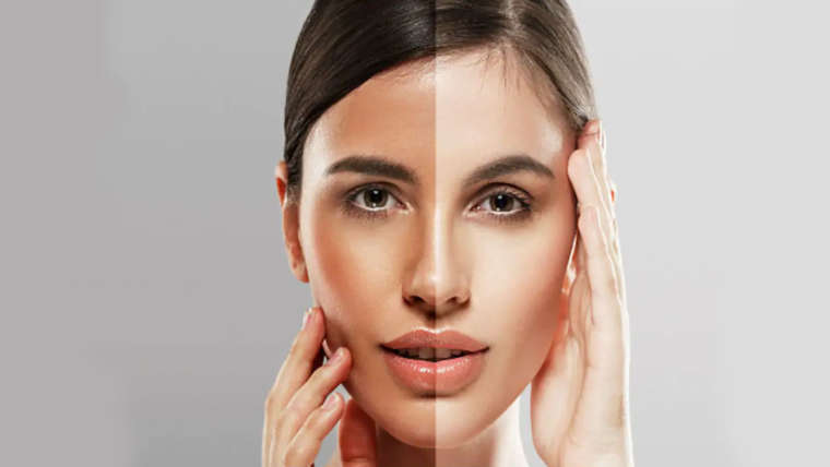 Photo facials/ Laser skin lightening