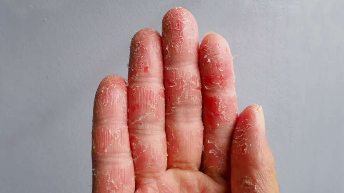 Atopic Dermatitis