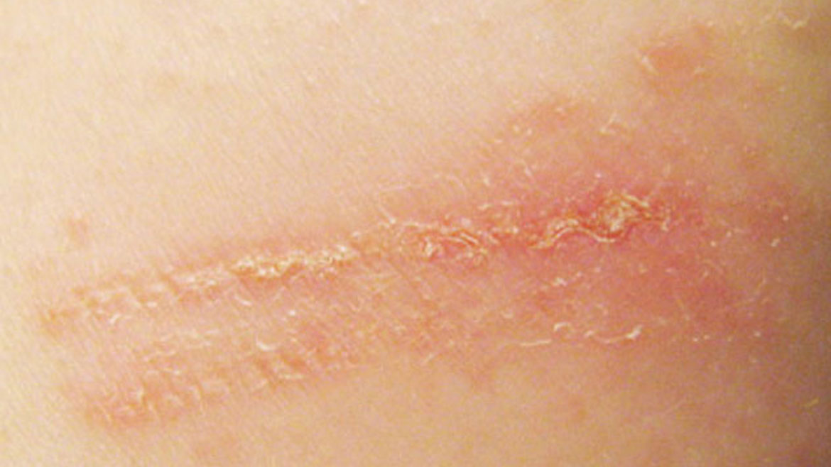 Contact Dermatitis