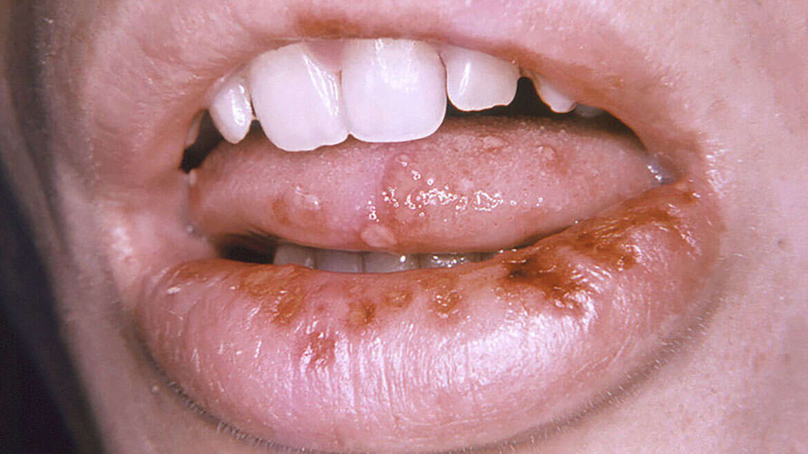 Herpetic infections