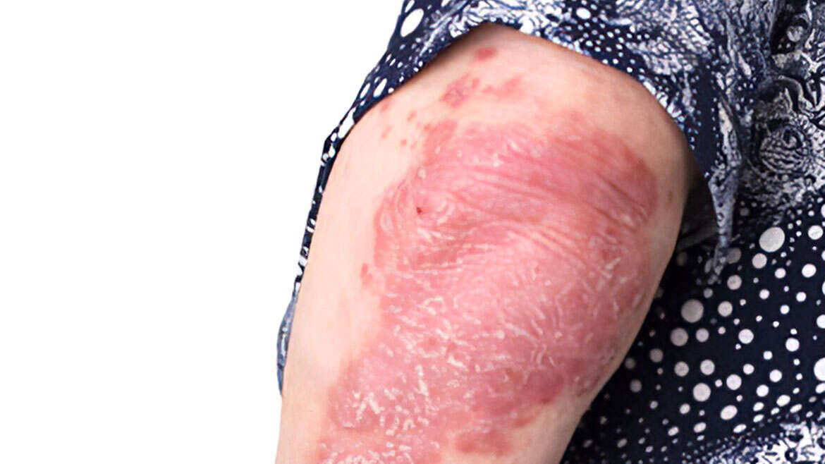 Skin Tuberculosis