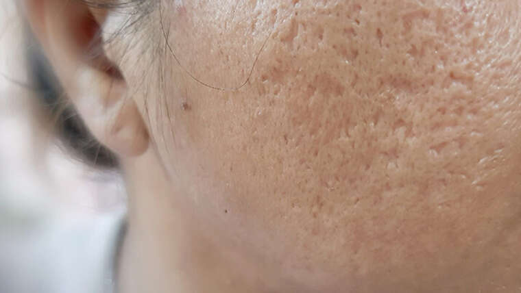 Acne Scars